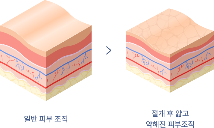 유앤미의원,유앤미클리닉,유앤미,강남유앤미,신논현유앤미,논현유앤미,서울유앤미클리닉,서울피부과,서울클리닉,한국피부과,이마거상리프팅,이마거상,실리프팅,얼굴리프팅,팔자주름,미간주름,안검하수,이마거상수술,거상수술,연예인수술,연예인성형외과,배우피부과,실리프팅가격,얼굴실리프팅,윤곽주사,얼굴지방흡입,얼굴지방이식,실리프팅비용,이마필러,얼굴필러,필러,필러잘하는곳,실리프팅잘하는곳,강남실리프팅,에피티콘실,에피티콘리프팅,민트실,민트실리프팅,리프팅유명한곳