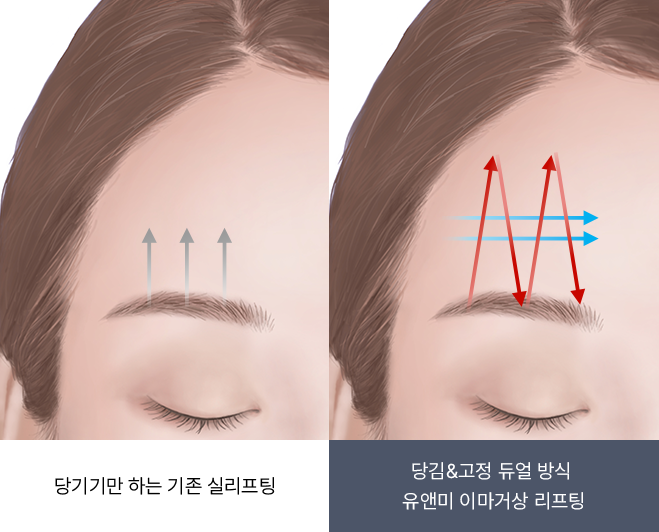 유앤미의원,유앤미클리닉,유앤미,강남유앤미,신논현유앤미,논현유앤미,서울유앤미클리닉,서울피부과,서울클리닉,한국피부과,이마거상리프팅,이마거상,실리프팅,얼굴리프팅,팔자주름,미간주름,안검하수,이마거상수술,거상수술,연예인수술,연예인성형외과,배우피부과,실리프팅가격,얼굴실리프팅,윤곽주사,얼굴지방흡입,얼굴지방이식,실리프팅비용,이마필러,얼굴필러,필러,필러잘하는곳,실리프팅잘하는곳,강남실리프팅,에피티콘실,에피티콘리프팅,민트실,민트실리프팅,리프팅유명한곳