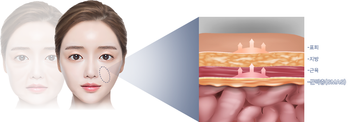 유앤미의원,유앤미클리닉,유앤미,강남유앤미,신논현유앤미,논현유앤미,서울유앤미클리닉,서울피부과,서울클리닉,한국피부과,팔자주름리프팅,실리프팅,고주파리프팅,팔자주름필러,팔자주름,팔자주름없애는법,팔자주름크림,주름패치,눈가주름,이마주름패치,팔자주름수술,귀족수술,고주파마사지기,리프팅기기