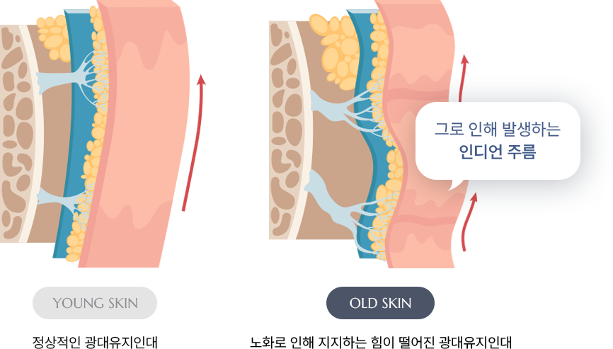 유앤미의원,유앤미클리닉,유앤미,강남유앤미,신논현유앤미,논현유앤미,서울유앤미클리닉,서울피부과,서울클리닉,한국피부과,인디언주름리프팅,인디언주름,얼굴주름리프팅,실리프팅잘하는곳,강남실리프팅,논현리프팅,팔자주름없애기,팔자주름시술,인디언주름시술,동안시술